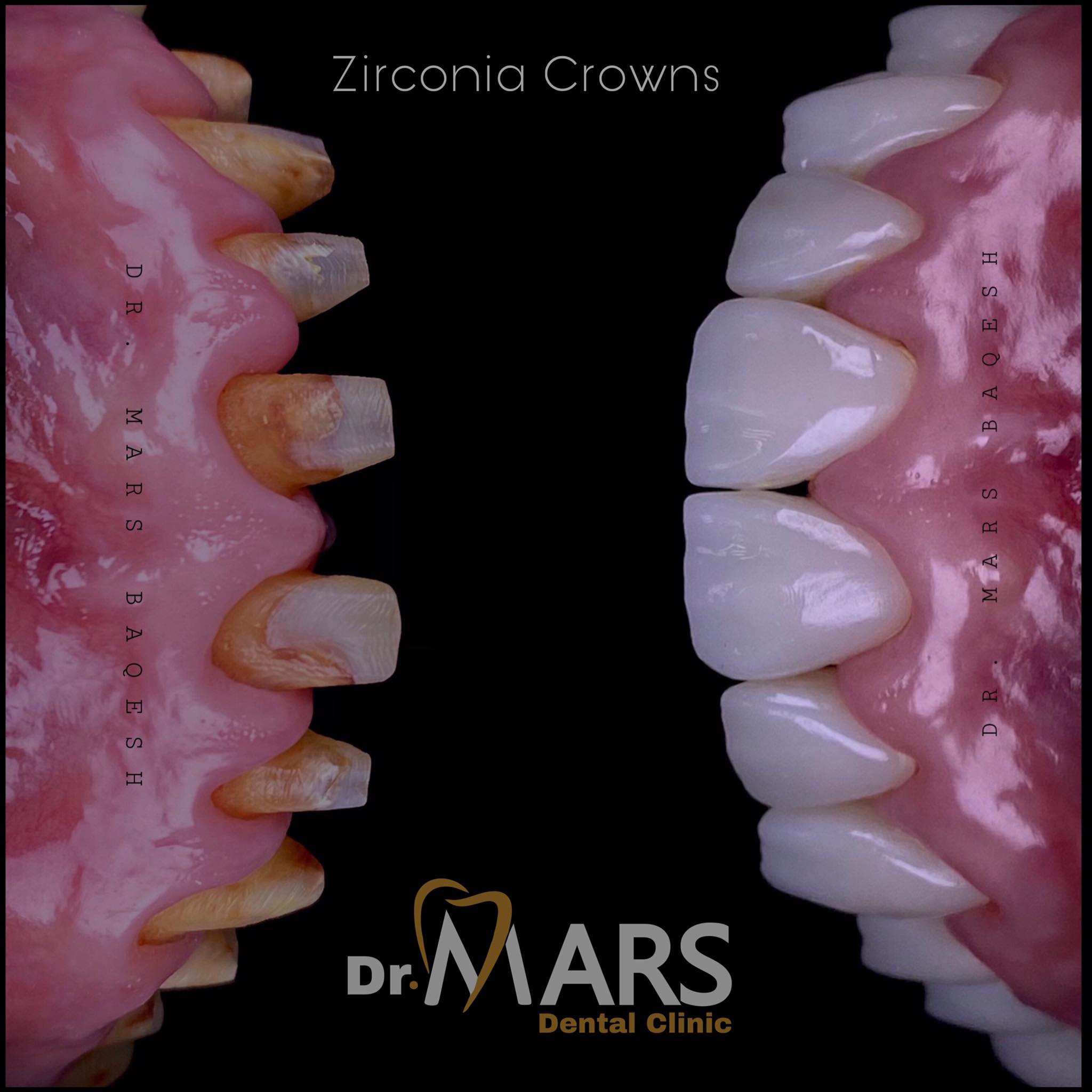 Zirconia Crowns
